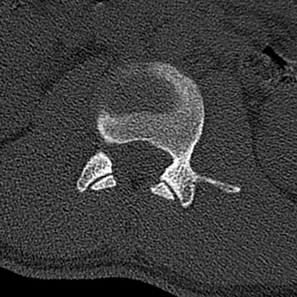 Burst fracture (Radiopaedia 53373-59357 Axial bone window 19).jpg