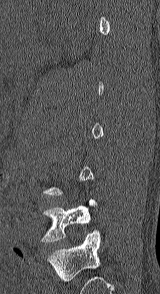 Burst fracture (Radiopaedia 53373-59357 Sagittal bone window 69).jpg