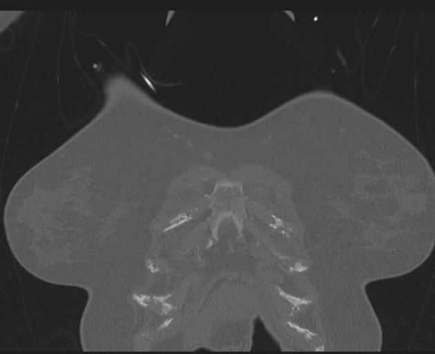 Burst fracture - thoracic spine (Radiopaedia 30238-30865 Coronal bone window 21).jpg