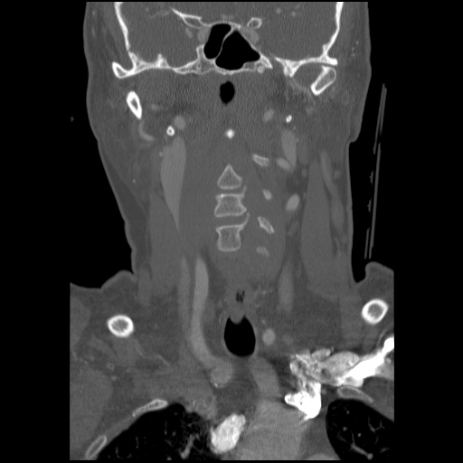 C1 anterior arch (plough) fracture - type 1 (Radiopaedia 76181-87720 Coronal bone window 65).jpg