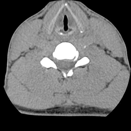 File:C5 facet fracture (Radiopaedia 58374-65499 Axial non-contrast 57).jpg