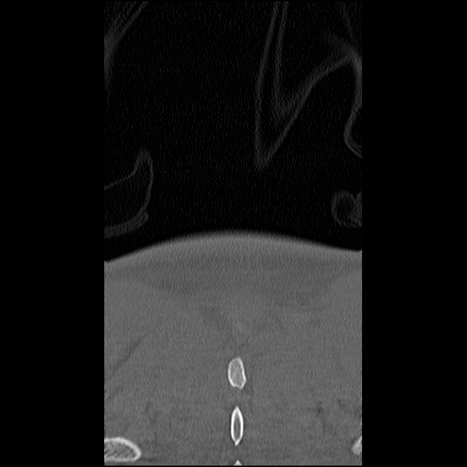C5 facet fracture (Radiopaedia 58374-65499 Coronal bone window 63).jpg
