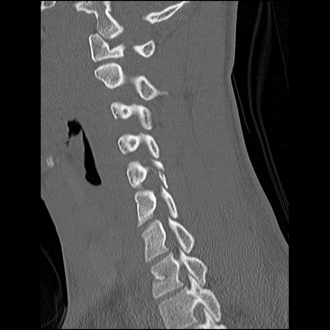 C5 facet fracture (Radiopaedia 58374-65499 Sagittal bone window 31).jpg