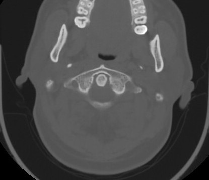 C7 laminar fracture and Klippel-Feil syndrome (Radiopaedia 86710-102850 Axial bone window 23).jpg