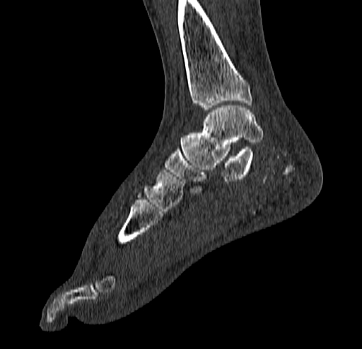 Calcaneal fracture - Sanders type 4 (Radiopaedia 90179-107370 Sagittal bone window 46).jpg