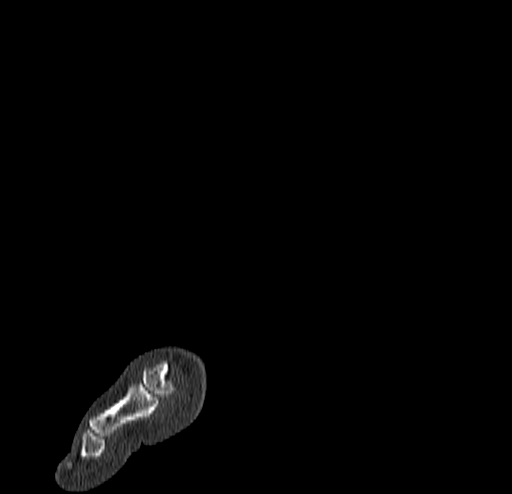 Calcaneal fracture - Sanders type 4 (Radiopaedia 90179-107370 Sagittal bone window 6).jpg