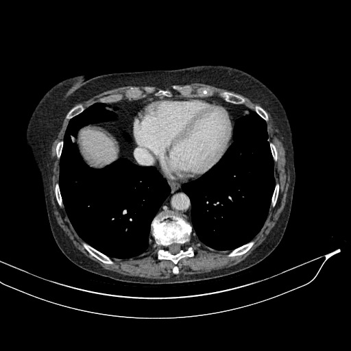 Calcified adrenal glands and Spigelian hernia (Radiopaedia 49741-54988 A 9).jpg