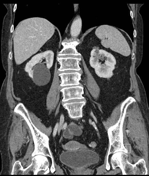 Calcified adrenal glands and Spigelian hernia (Radiopaedia 49741-54988 B 72).jpg