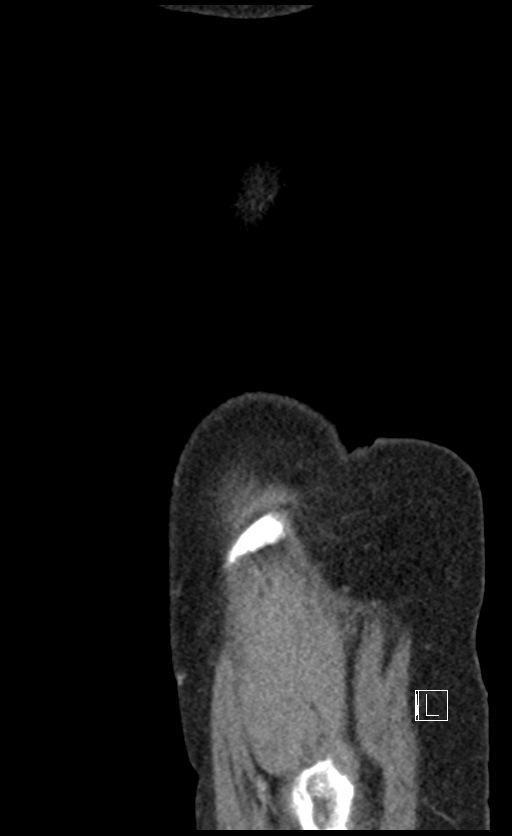 Calcified adrenal glands and Spigelian hernia (Radiopaedia 49741-54988 C 3).jpg