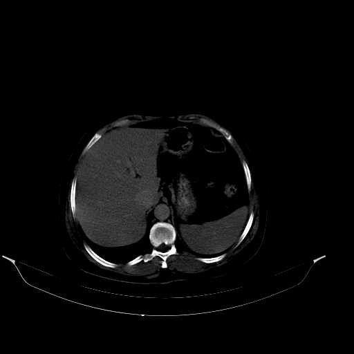 File:Calcified hydatid cyst of the liver (Radiopaedia 21212-21112 Axial bone window 13).jpg