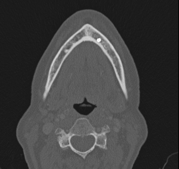 Caldwell-Luc operation (Radiopaedia 52329-58225 Axial bone window 65).jpg