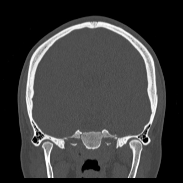 Calvarial osteoma (Radiopaedia 36520-38079 C 47).jpg