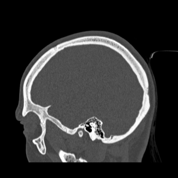 Calvarial osteoma (Radiopaedia 36520-38079 Sagittal bone window 83).jpg