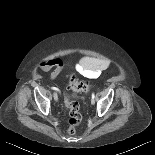 Cannonball metastases from endometrial cancer (Radiopaedia 42003-45031 E 65).png