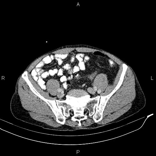 Caput medusae sign - portal hypertension (Radiopaedia 64007-72759 A 75).jpg