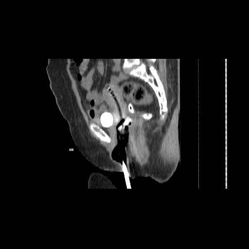 File:Carcinoma cervix- brachytherapy applicator (Radiopaedia 33135-34173 D 81).jpg