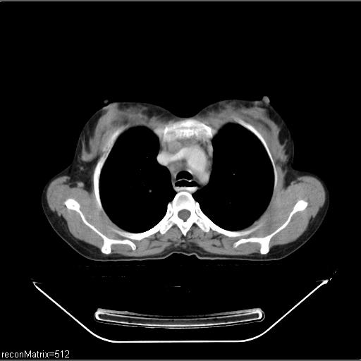 File:Carcinoma of esophagus (Radiopaedia 27356-27550 A 25).jpg