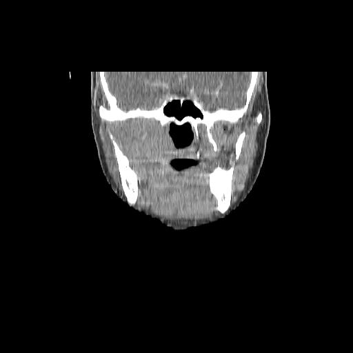 Carcinoma of the maxillary antrum (Radiopaedia 53805-59888 Coronal C+ delayed 67).jpg