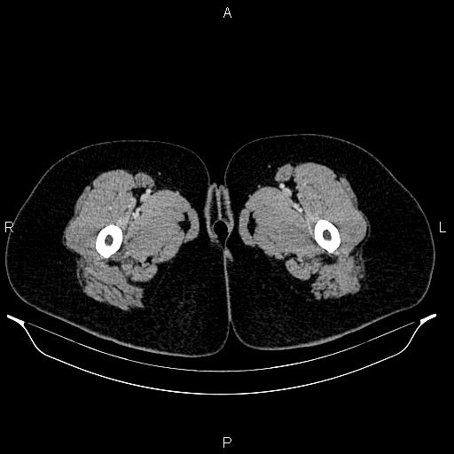 Carcinoma of uterine cervix (Radiopaedia 85861-101700 A 85).jpg