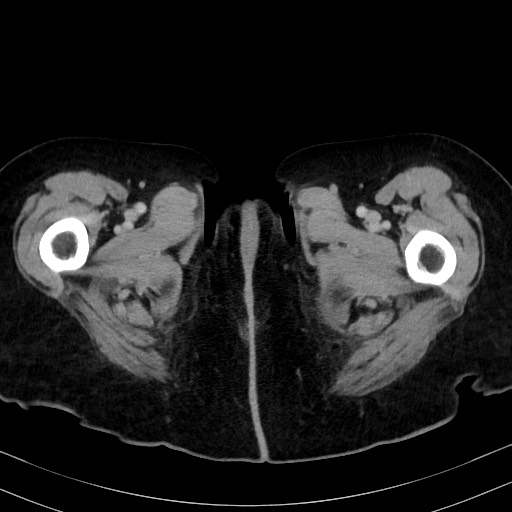 Carcinosarcoma (Radiopaedia 70401-80503 A 79).jpg