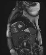Cardiac amyloidosis (Radiopaedia 51404-57150 Sagittal CINE SSFP 131).jpg