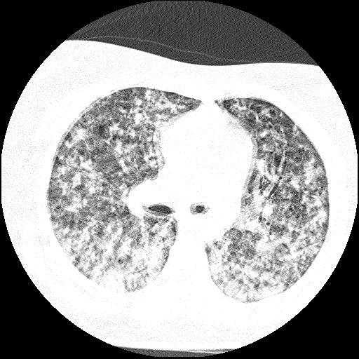 File:Cardiac angiosarcoma (Radiopaedia 66010-75181 Axial lung window 56).jpg
