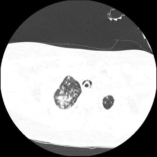 Cardiac angiosarcoma (Radiopaedia 66010-75181 Axial lung window 83).jpg