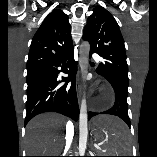 Cardiac tumor - undifferentiated pleomorphic sarcoma (Radiopaedia 45844-50134 Coronal non-contrast 43).png