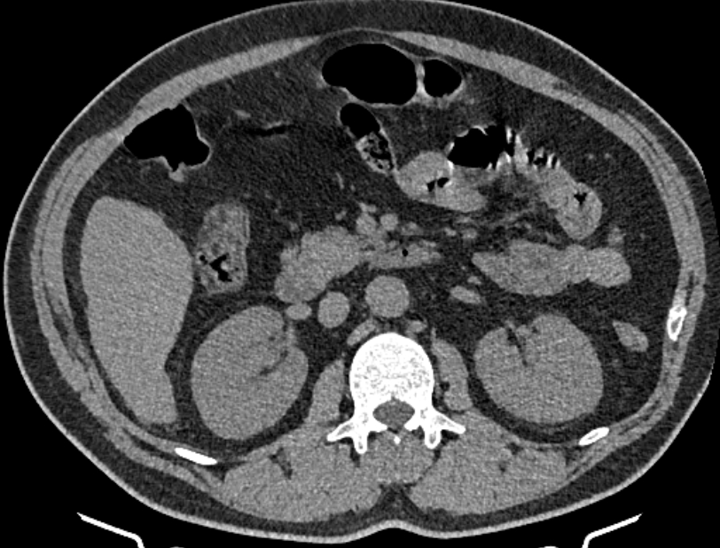 Cardiogenic pulmonary edema (Radiopaedia 68180-77678 Axial non-contrast 78).jpg
