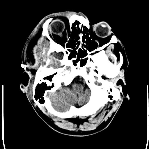 File:Carotid arterial dissection (Radiopaedia 30001-30548 Axial non-contrast 3).jpg