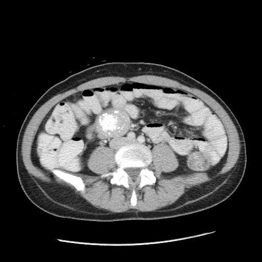 File:Castleman disease with fibrous pseudotumor in the abdomen (Radiopaedia 77296-89373 Axial 2).jpg