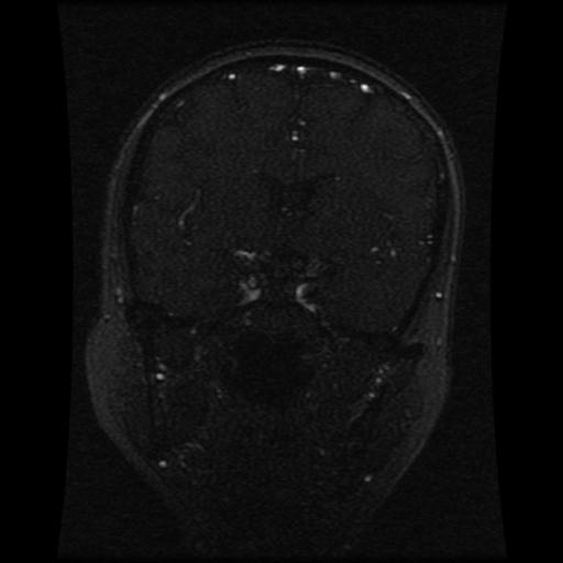Cavernoma with developmental venous anomaly (Radiopaedia 22470-22507 MRV 80).jpg
