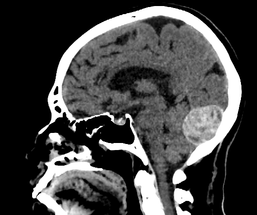 Cavernous hemangioma of the cerebellar falx (Radiopaedia 73025-83723 B 157).jpg
