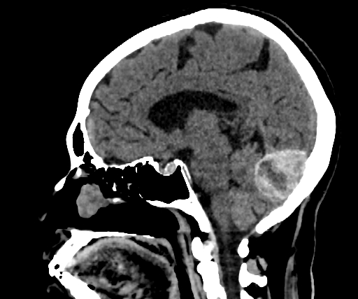Cavernous hemangioma of the cerebellar falx (Radiopaedia 73025-83723 B 176).jpg