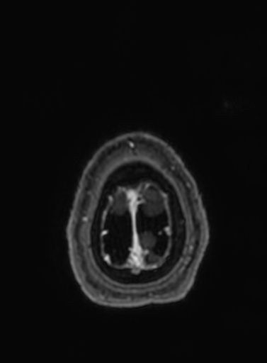 File:Cavernous hemangioma of the cerebellar falx (Radiopaedia 73025-83724 Axial T1 C+ 22).jpg
