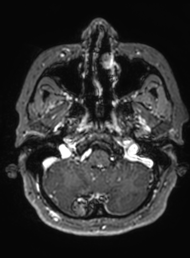 File:Cavernous hemangioma of the cerebellar falx (Radiopaedia 73025-83724 Axial T1 C+ 282).jpg