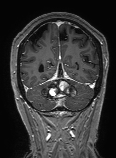 Cavernous hemangioma of the cerebellar falx (Radiopaedia 73025-83724 Coronal T1 C+ 291).jpg
