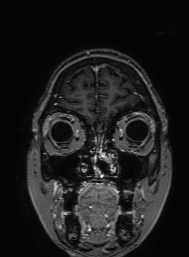 Cavernous hemangioma of the cerebellar falx (Radiopaedia 73025-83724 Coronal T1 C+ 54).jpg