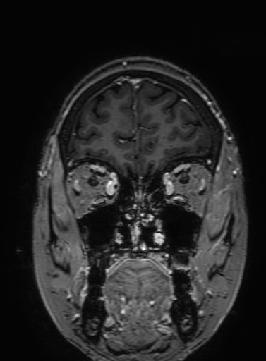 Cavernous hemangioma of the cerebellar falx (Radiopaedia 73025-83724 Coronal T1 C+ 73).jpg