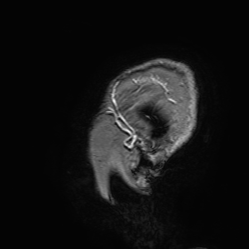 Cavernous hemangioma of the cerebellar falx (Radiopaedia 73025-83724 Sagittal T1 C+ 208).jpg