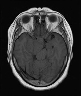 File:Cavernous sinus meningioma (Radiopaedia 63682-72367 Axial T1 9).jpg