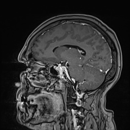 Cavernous sinus meningioma (Radiopaedia 63682-72367 Sagittal T1 C+ 102).jpg
