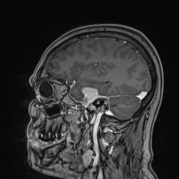 Cavernous sinus meningioma (Radiopaedia 63682-72367 Sagittal T1 C+ 59).jpg