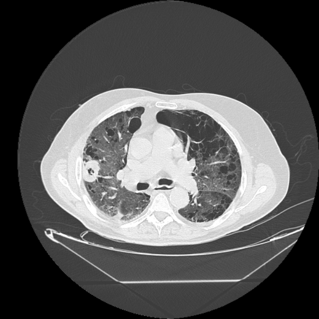 Cavitating bronchogenic carcinoma (Radiopaedia 44489-48162 Axial lung window 36).jpg