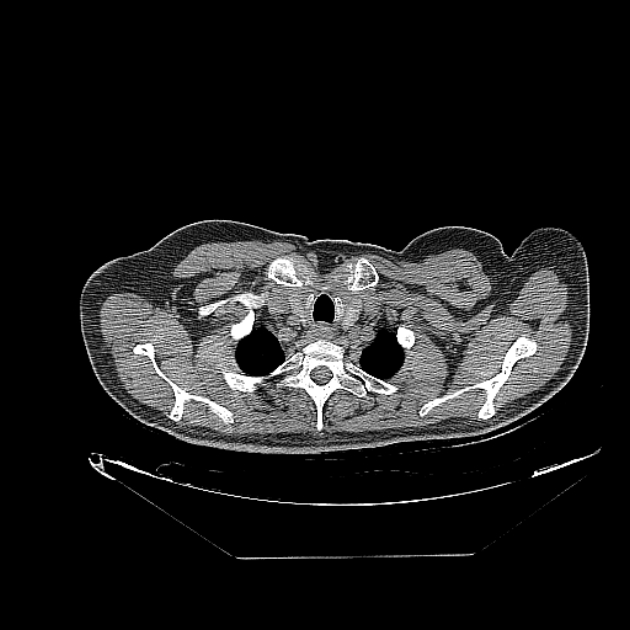 Cavitating bronchogenic carcinoma (Radiopaedia 44489-48162 Axial non-contrast 3).jpg