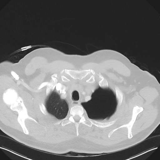 File:Cavitating pneumonia complicated by pneumothorax (Radiopaedia 48149-52994 Axial lung window 9).png