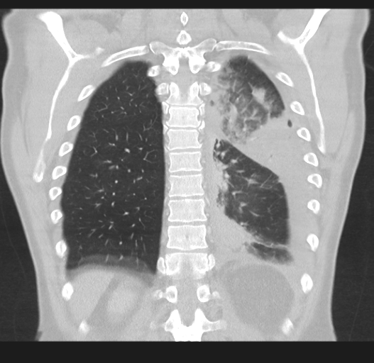 Cavitating pneumonia complicated by pneumothorax (Radiopaedia 48149-52994 Coronal lung window 45).png