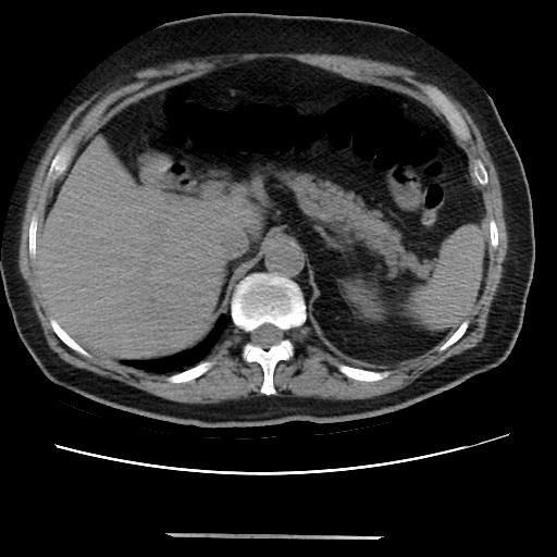 File:Cavitating pulmonary metastases (Radiopaedia 89545-106544 Axial non-contrast 56).jpg