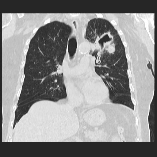 File:Cavitating pulmonary metastases (Radiopaedia 89545-106544 Coronal lung window 20).jpg