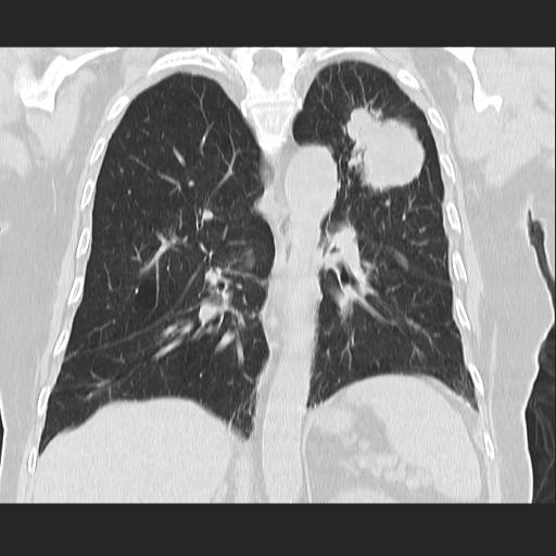File:Cavitating pulmonary metastases (Radiopaedia 89545-106544 Coronal lung window 27).jpg